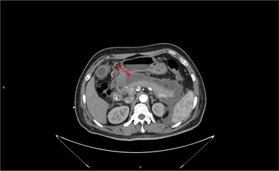 Severe hyperlipidemia pancreatitis induced by taking tamoxifen after breast cancer surgery—Case report